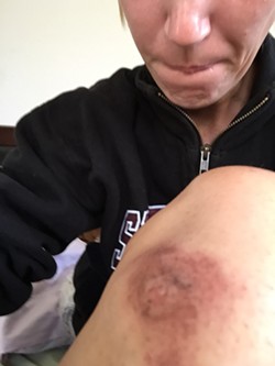 AFTERMATH:  Grover Beach resident Andrea Hansen, who has epilepsy, claims she sustained this and other injuries in a scuffle with police that occurred when she was arrested after calling 911 to report that she was having multiple seizures. - PHOTO COURTESY OF GOFUNDME