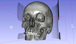PICTURE PERFECT:  In order to create the full 3-D render, Balzer had to use Photoshop for some of the more detailed work. What resulted was an accurate, full-scale model of Scott&rsquo;s skull (including the tumor) made out of layered plastic. - IMAGE COURTESY OF MICHAEL BALZER